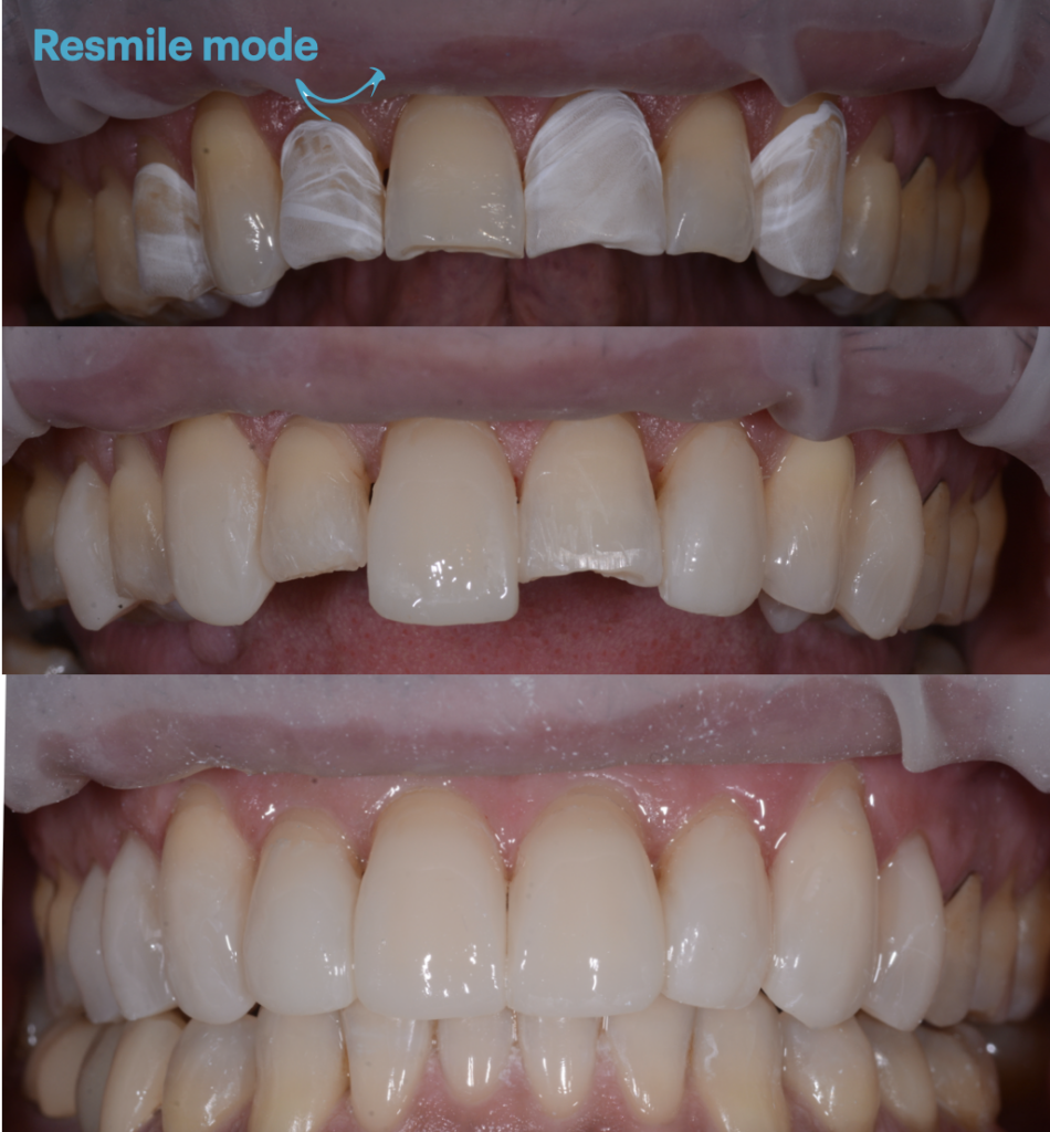 denti fratturati 