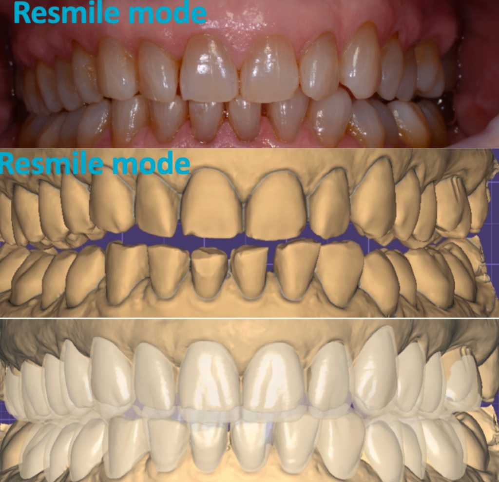 resmile 