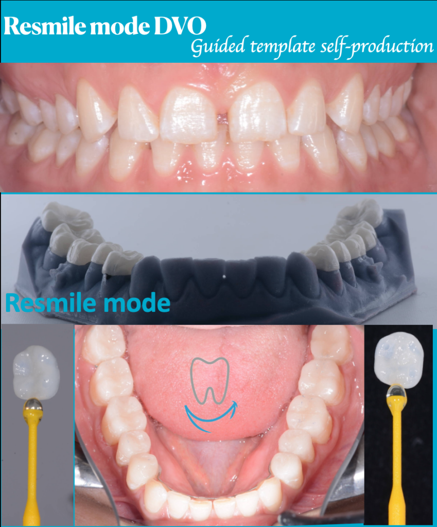 resmile 