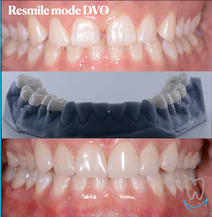 resmile 
