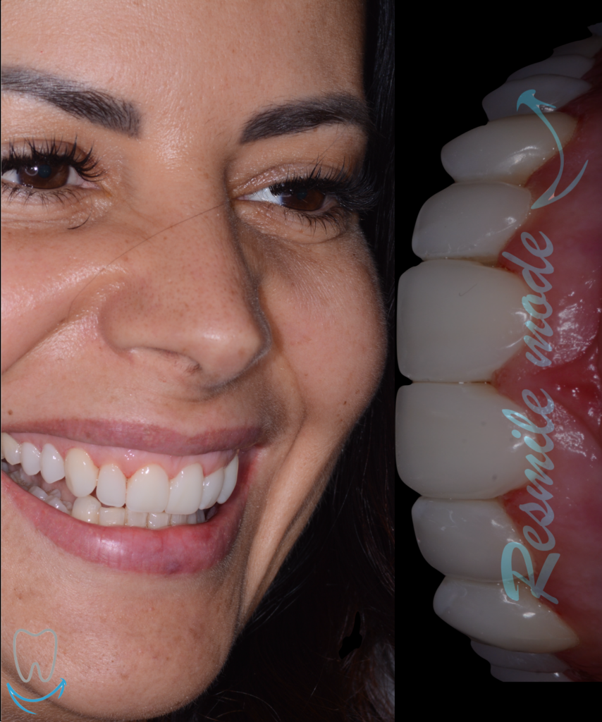 sorriso resmile