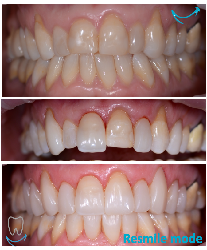 resmile prima e dopo 
